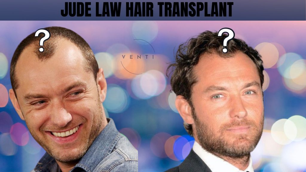 Естественный результат пересадки волос FUE, запланированной в Venti Hair Center Istanbul