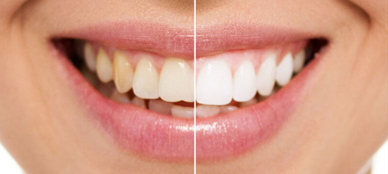 Lamine Veneers