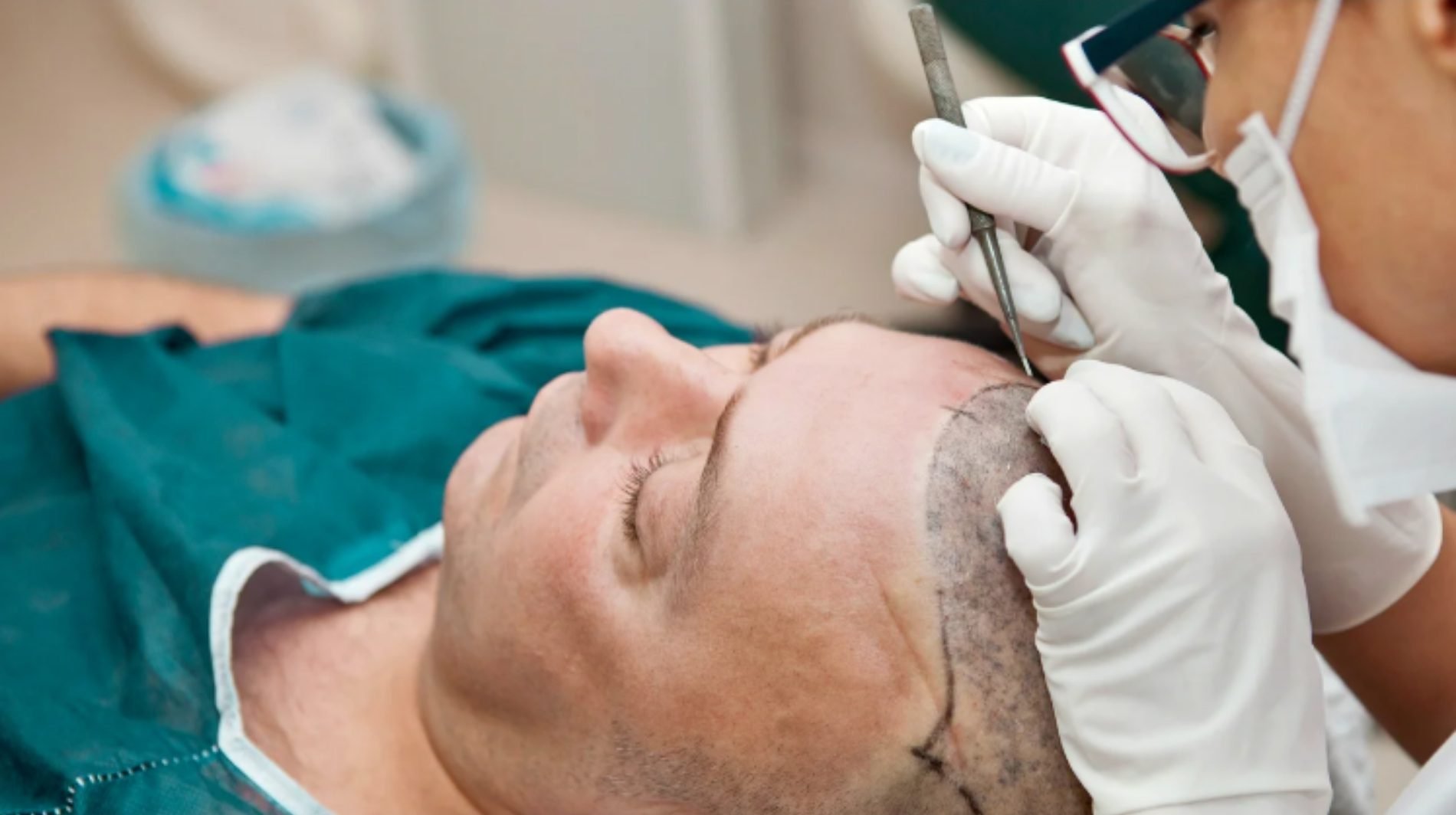 أطباء مؤهلون يجرون عملية زراعة شعر في عيادة مرخصة في Istanbul، تركيا