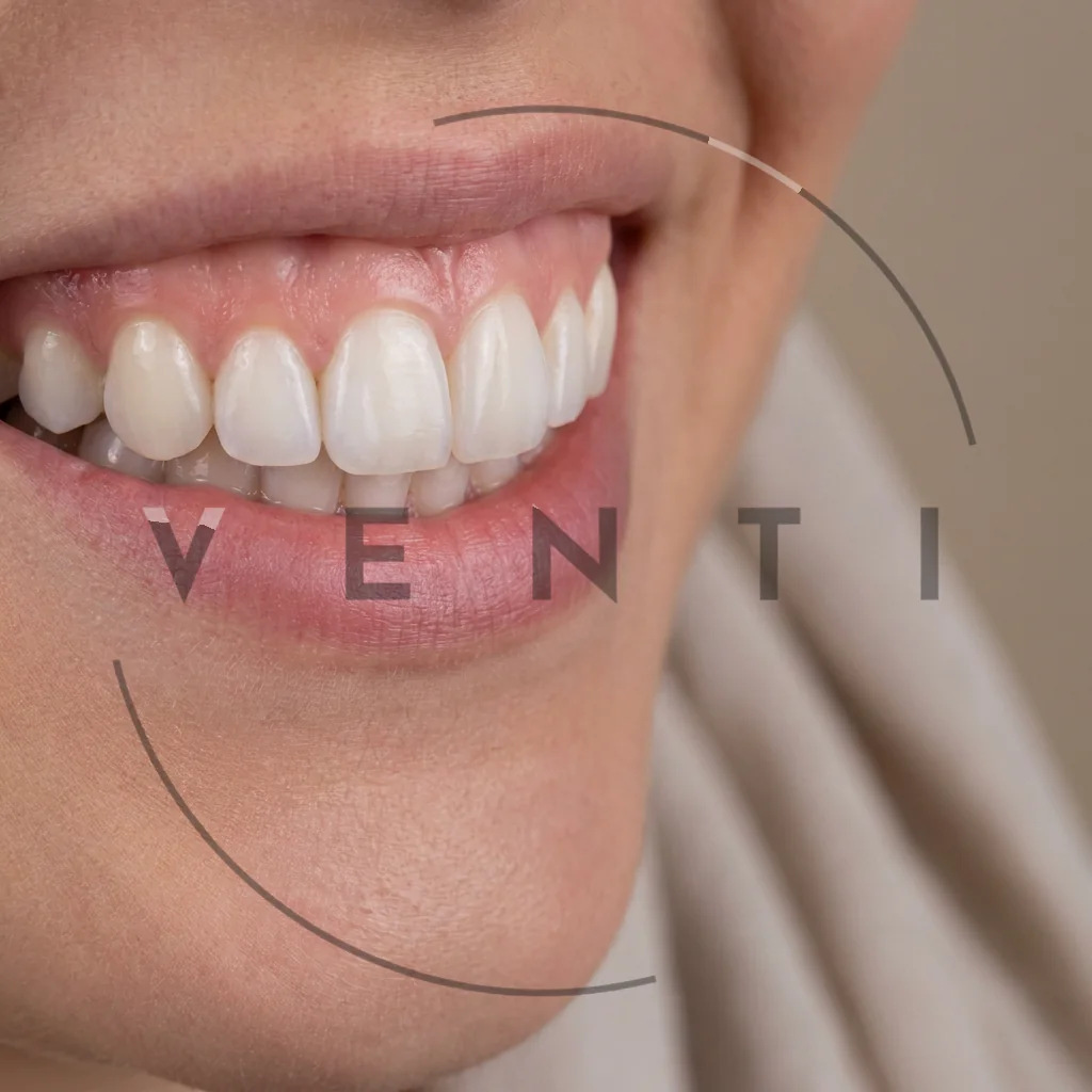 Composite bonding in Istanbul