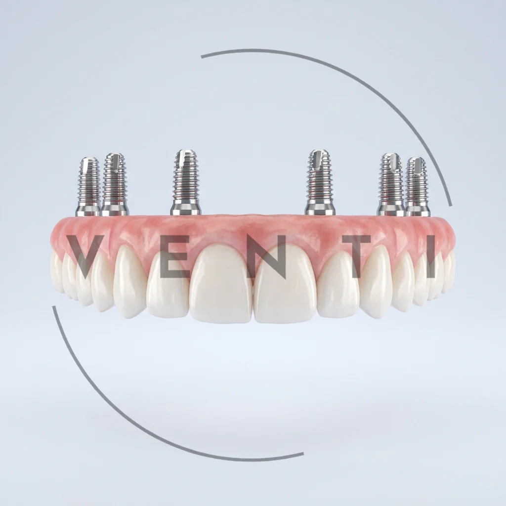 All-on-6 dental implants in Istanbul