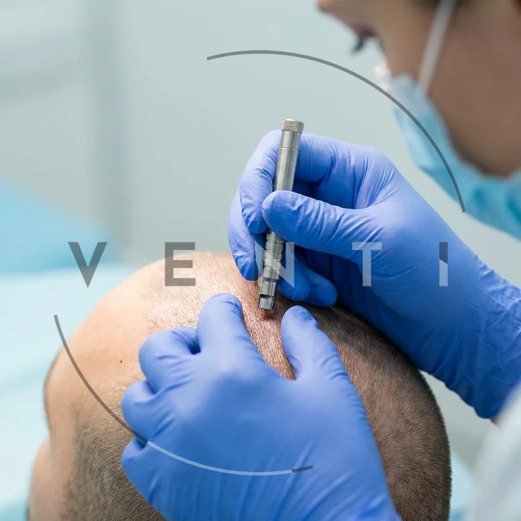 FUE hair transplant in Istanbul