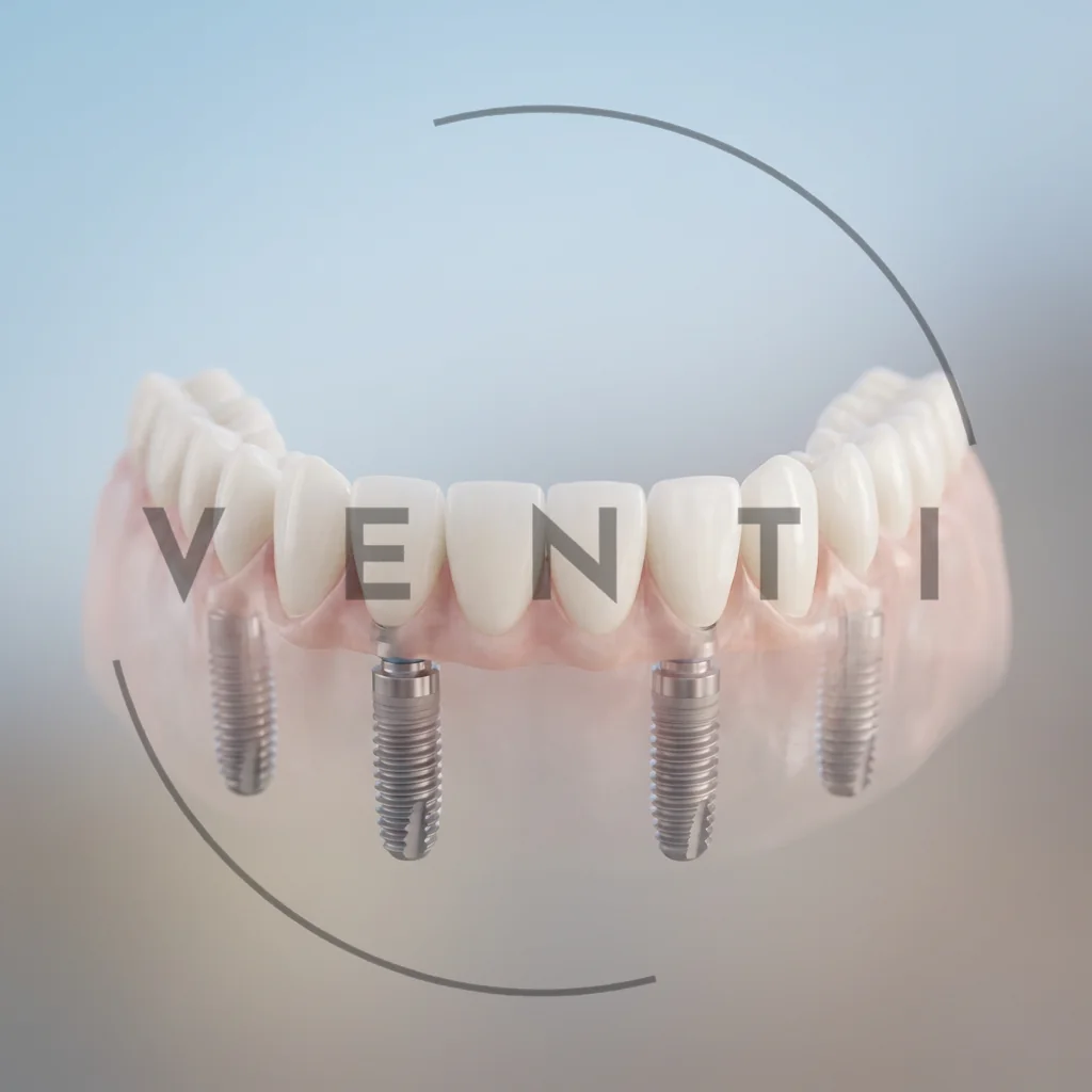 All-on-4 dental implants in Istanbul