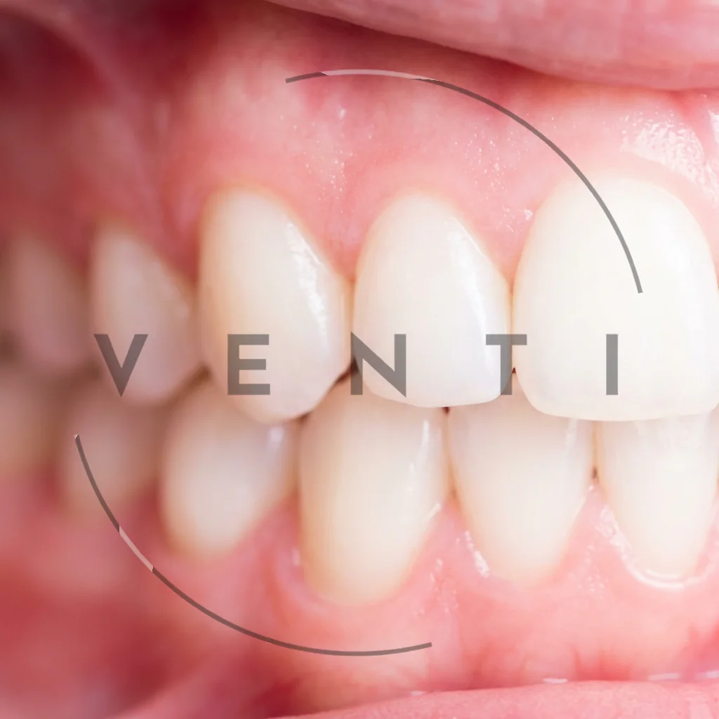 Gum disease treatment in Istanbul