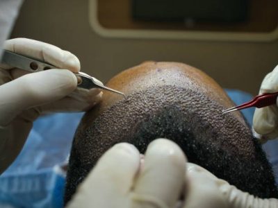 Close-up of a hair transplant graft implantation procedure at Venti Istanbul