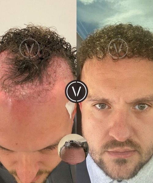 Curly hair transplant before and after, front view, at Venti Istanbul