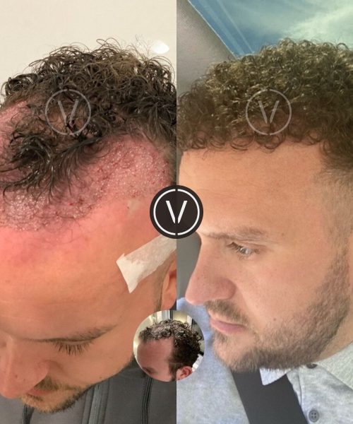 Curly hair transplant before and after result at Venti Istanbul