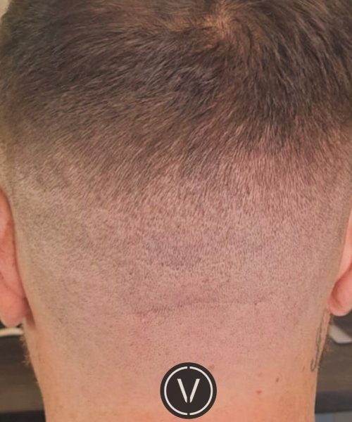 Healed donor area at the back of the head after a hair transplant at Venti
