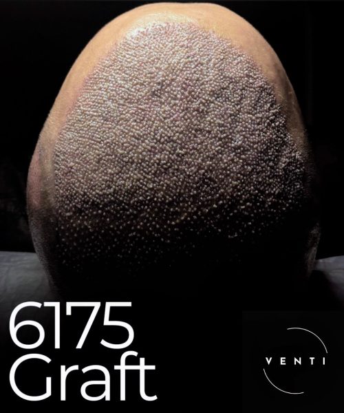 Hair transplant with 6175 grafts immediately after the procedure at Venti Istanbul
